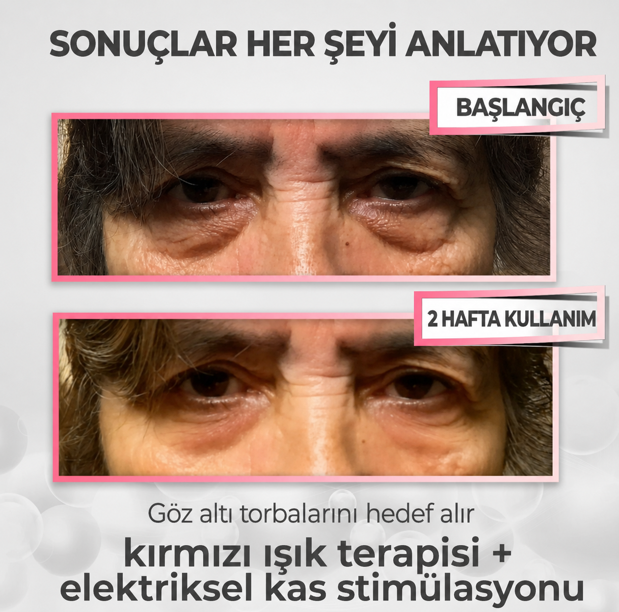 LumiEye® 2'si 1 Arada Kırmızı Işık Terapisi + EMS ile Göz Altı Torbalarını Yok Edin