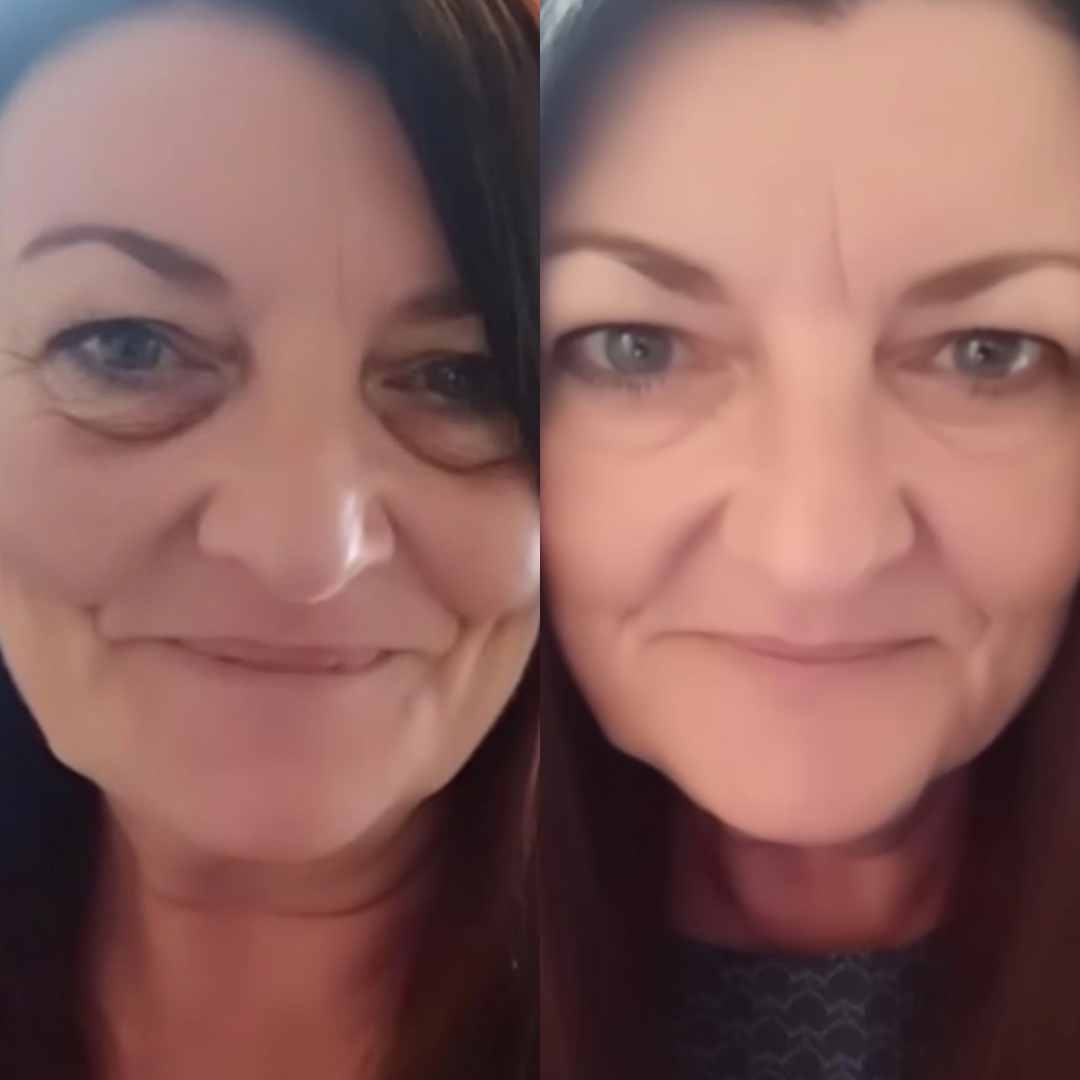 LumiEye® 2'si 1 Arada Kırmızı Işık Terapisi + EMS ile Göz Altı Torbalarını Yok Edin